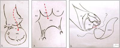 Aortic root enlargement in patients undergoing mitral and aortic replacement: early outcomes in a sub-Saharan population